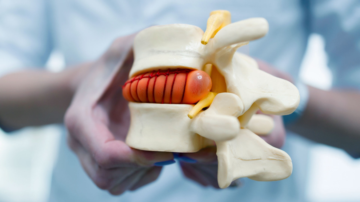 Hernia Discal